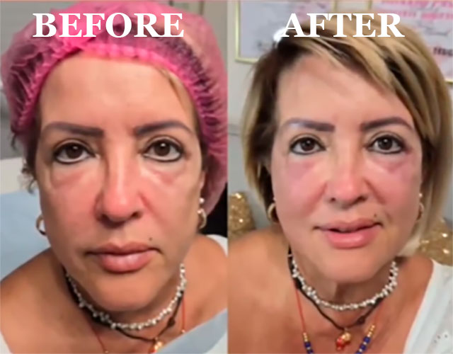 Facial volume restoration with hyaluronic acid