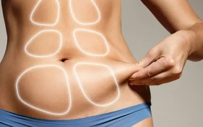 Mesotherapy to reduce localized fat
