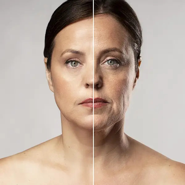 Microneedling with exosomes treatment, enhance skin appearance through advanced anti-aging and tissue regeneration effects